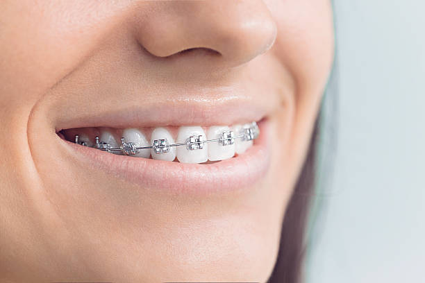 Best Invisalign and Clear Aligners  in Flence, OR